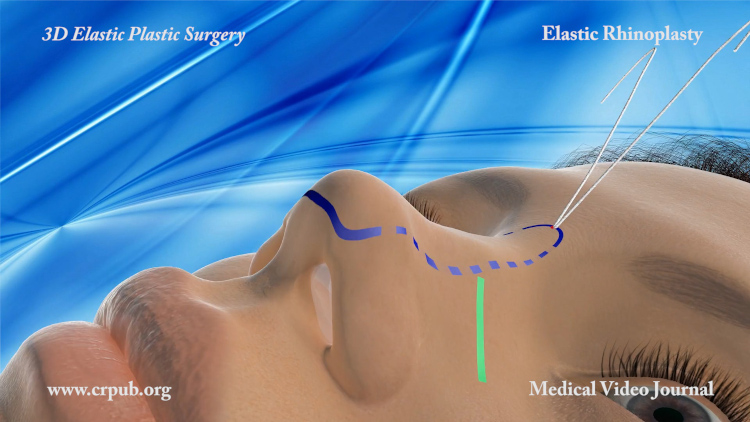 Elastic Rhinoplasty threads traction